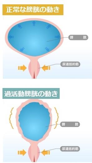 正常な膀胱と過活動膀胱との動きの比較