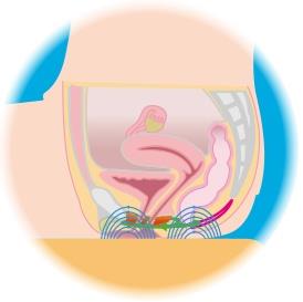 過活動膀胱の治療法　磁気刺激療法
