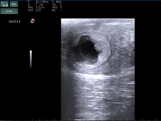 臨床画像　受精後26日　胚・尿膜囊
