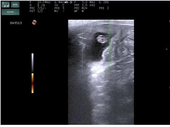 臨床画像　受精後31日の胚