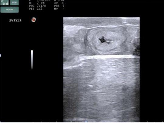 臨床画像　受精後22日の胚