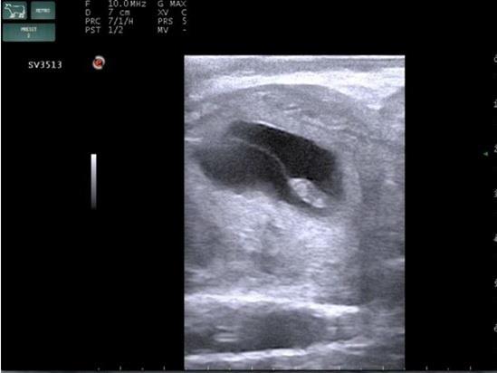 臨床画像　受精後27日　双胎子