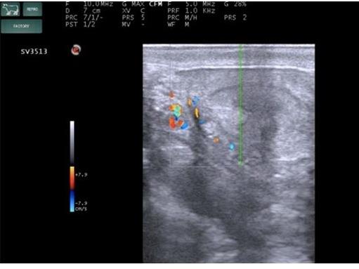 臨床画像　子宮の血流のカラードップラー像